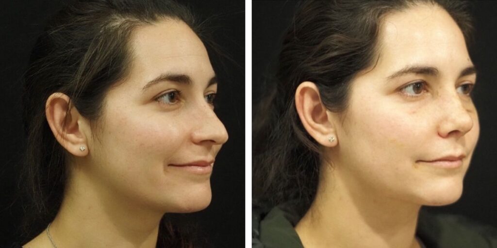Side-by-side comparison of a woman's profile before and after cosmetic treatment, showing subtle changes in skin texture and facial contours. Saxon MD