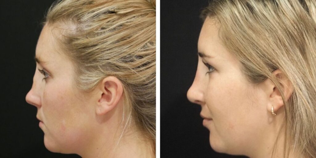 Side profiles of a blonde woman before and after a cosmetic procedure, showing changes in nose and chin structure against a black background. Saxon MD