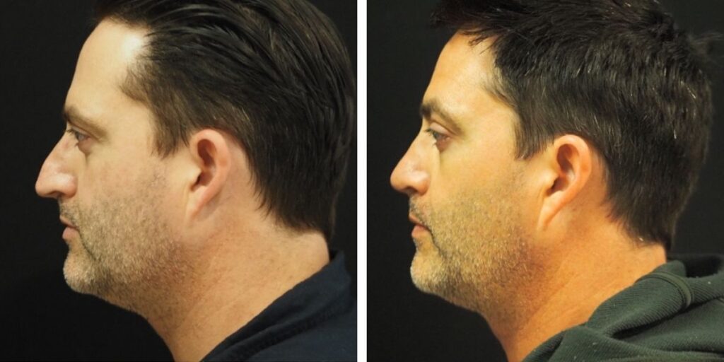 Side-by-side profile views of a middle-aged man before and after a haircut and grooming, set against a black background. Saxon MD