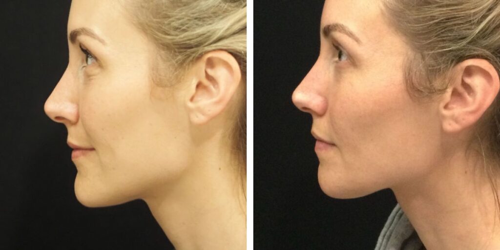 Side-by-side profile views of a woman with blonde hair, focusing on her facial features against a black background. Saxon MD
