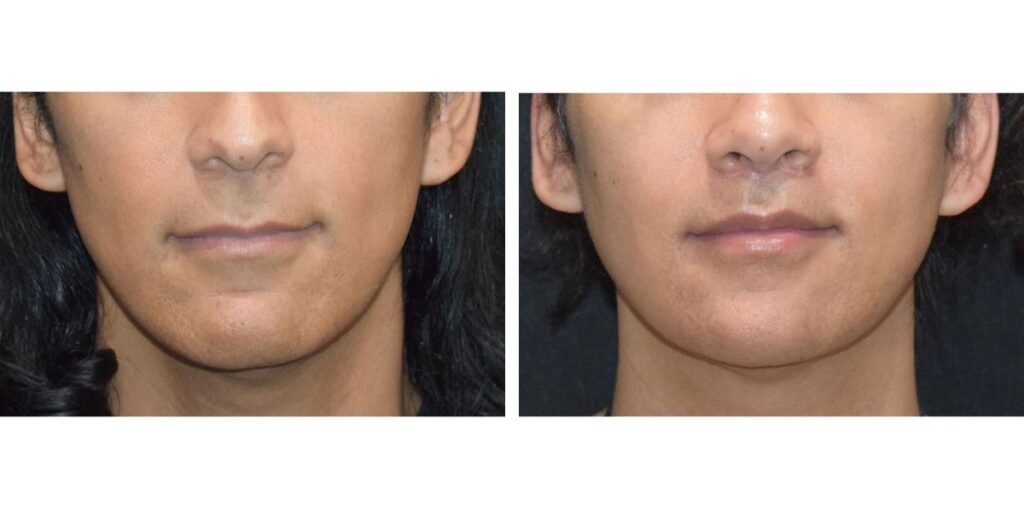 Side-by-side comparison of a man's nose before and after a cosmetic procedure, showing subtle changes in shape and contour. Saxon MD