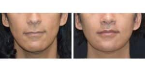 how to get a better jawline