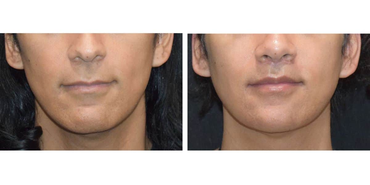 Jaw Contouring | Facial Plastic Surgery Austin & Dallas, TX