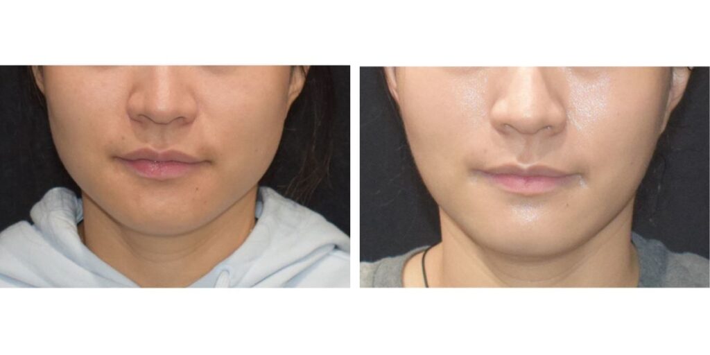 Close-up comparison of a woman’s face before and after cosmetic treatment, focusing on the skin and lips. Saxon MD