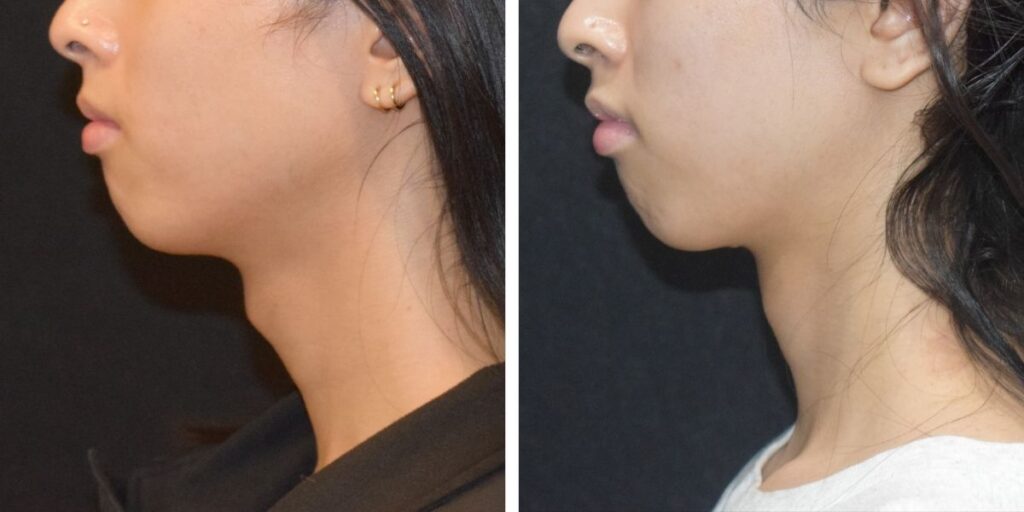 Side profile comparison of two individuals with different jawlines against a black background. Saxon MD