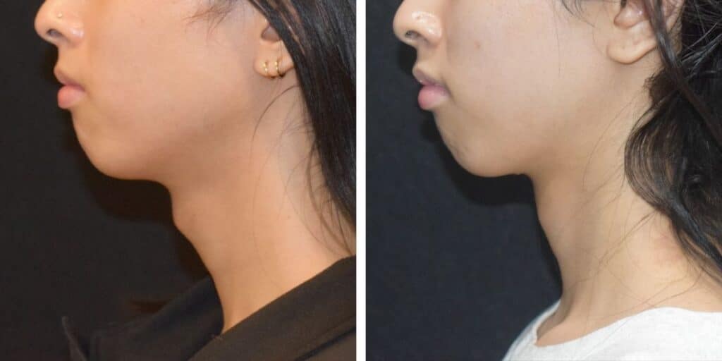 Adam's apple reduction before and after at Saxon MD