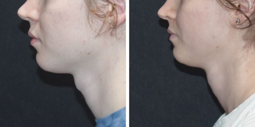 Side-by-side profile views of a person's face, before and after makeup, highlighting the skin's texture and complexion changes. Saxon MD