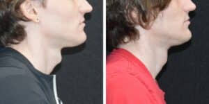 Tracheal Shave Cost In 2025 | Adam's Apple Reduction