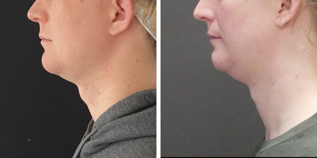 Side profile comparison of a person with blonde hair against a dark background, illustrating differences in posture or facial features. Saxon MD