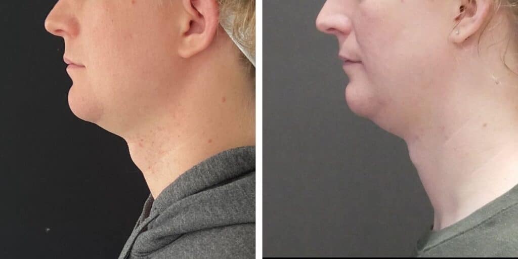 Side profile comparison of a person with blonde hair against a dark background, illustrating differences in posture or facial features. Saxon MD