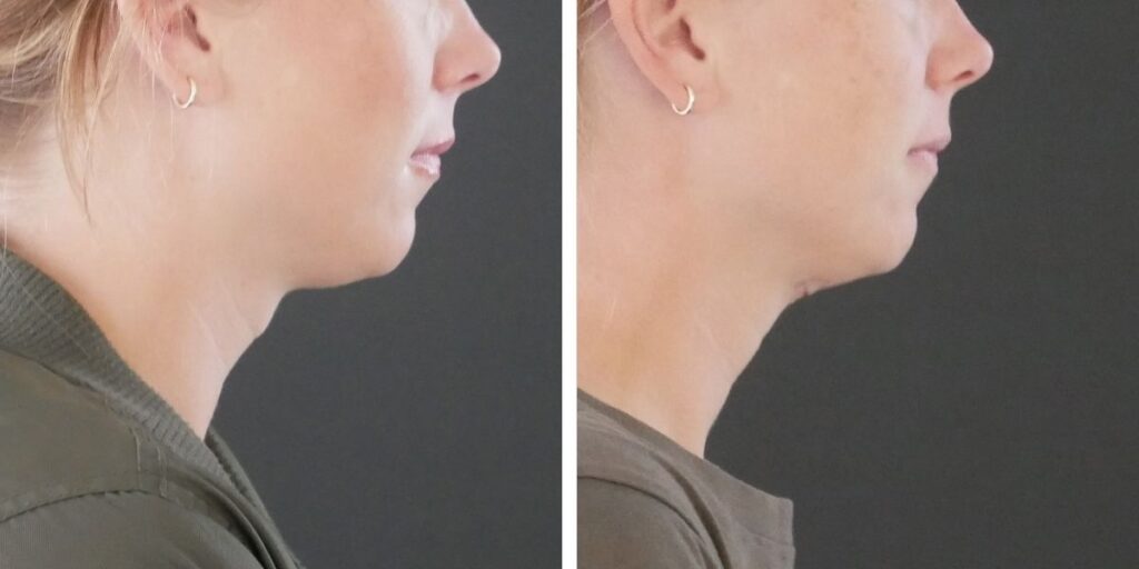 Side-by-side comparison of a woman's profile views before and after a subtle cosmetic procedure, showing slight changes in the jawline and neck. Saxon MD