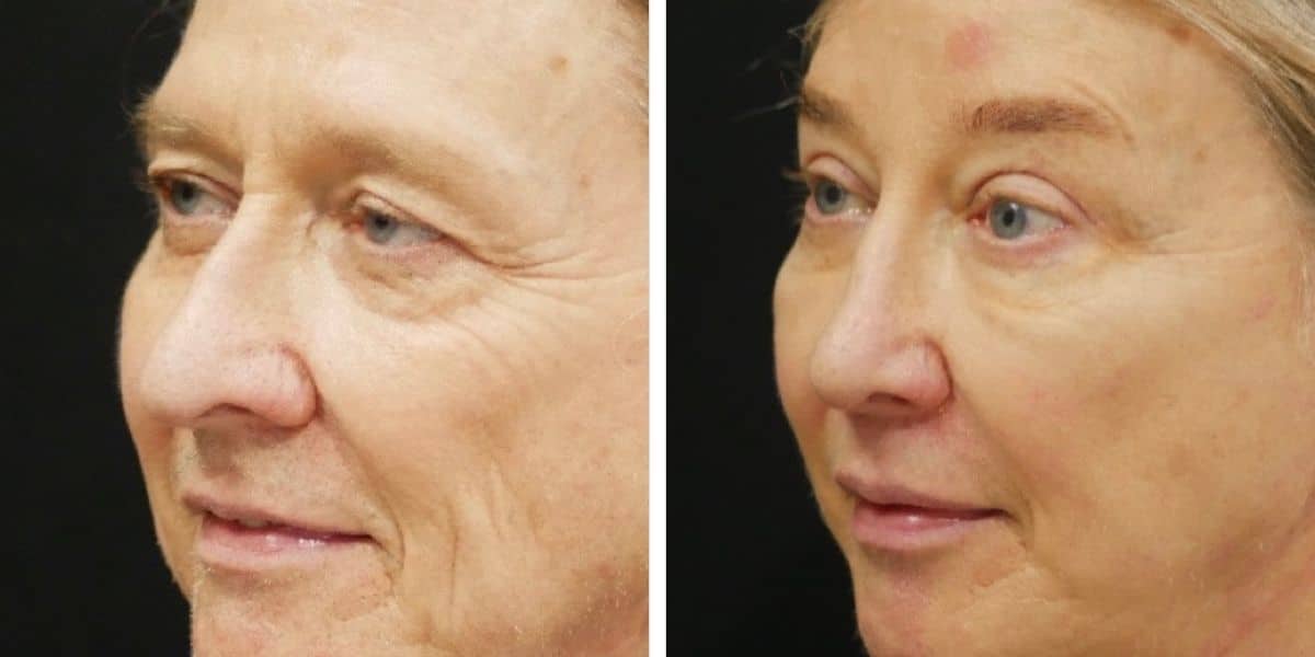 Blepharoplasty Before And After | Austin & Dallas, TX