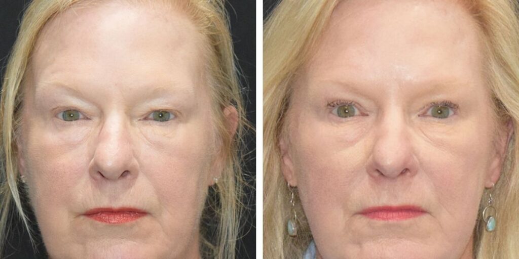 Before and after photos of a woman's face, showing rejuvenation treatments with clearer skin and reduced wrinkles. Saxon MD