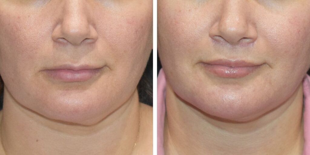 Close-up comparison of a woman's face before and after a cosmetic procedure, showing subtle changes in facial contours and skin texture. Saxon MD