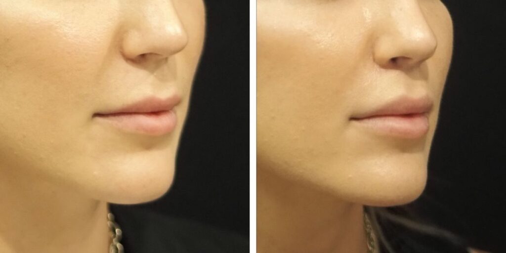 Close-up of a woman's lower face showing her nose, mouth, and chin before and after cosmetic treatment, on a black background. Saxon MD