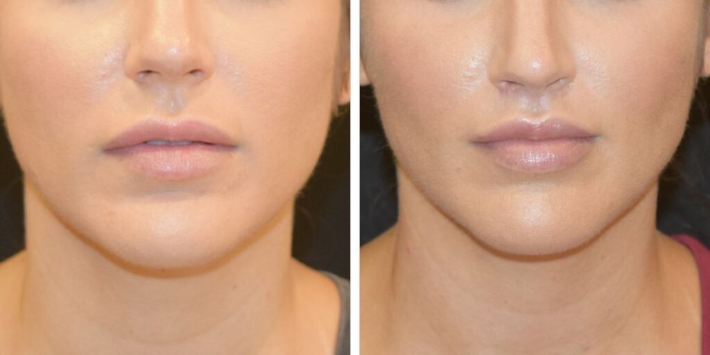 Before and after comparison of a woman's lips, showing subtle enhancement and increased fullness in the after photo. Saxon MD