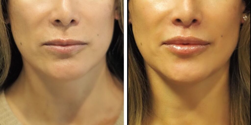 Before and after close-up of a woman's lower face showing improved skin tone and reduced blemishes. Saxon MD
