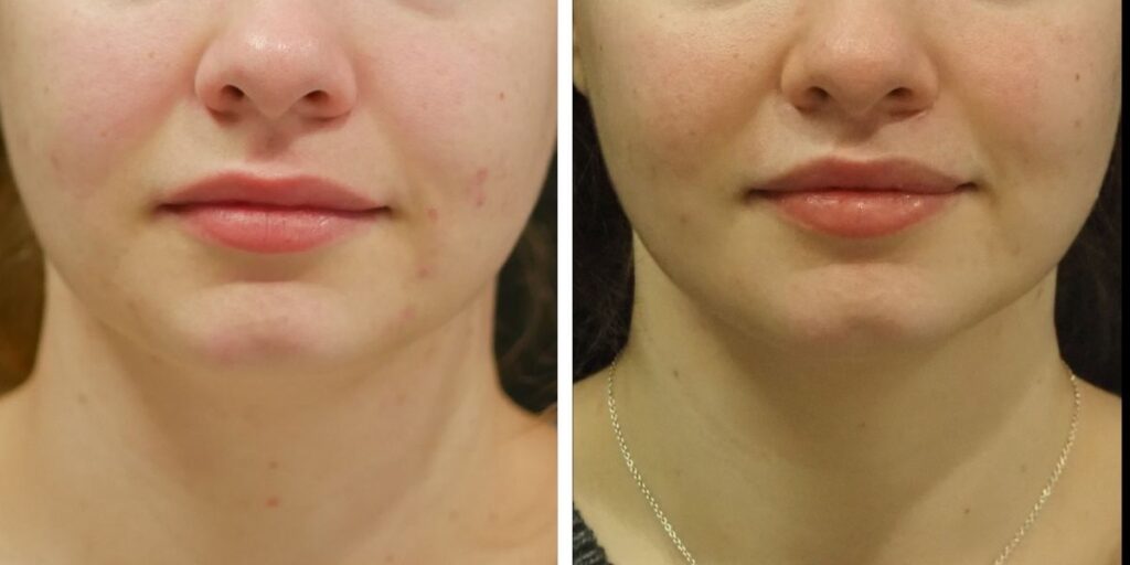 Before and after close-up of a woman's face showing improvement in skin condition, with reduced acne in the after image. Saxon MD
