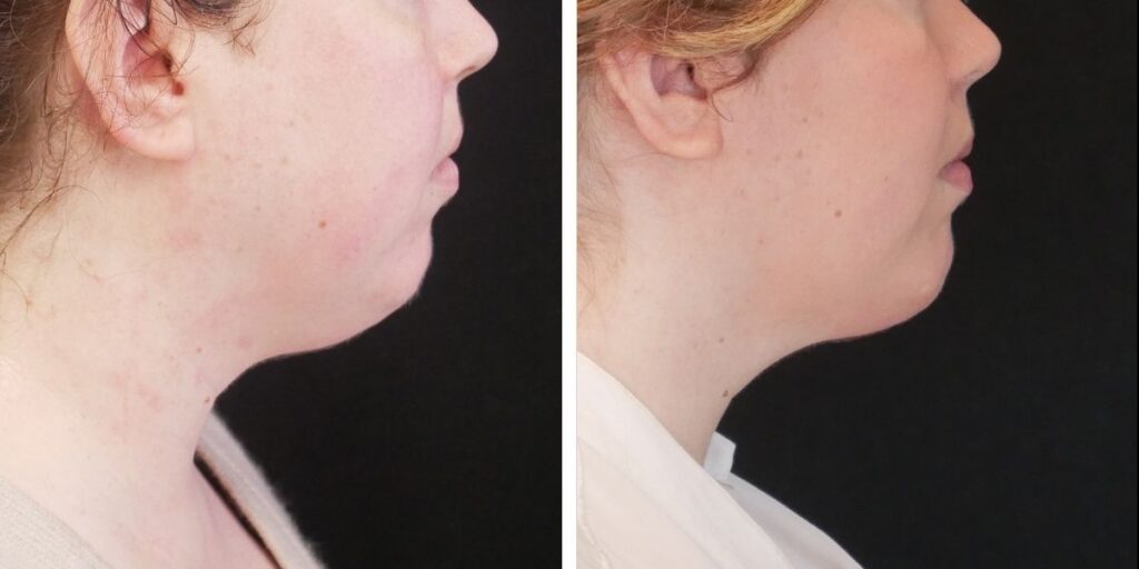 Side-by-side profile views of a woman before and after cosmetic treatment, showing changes in skin texture and jawline definition. Saxon MD