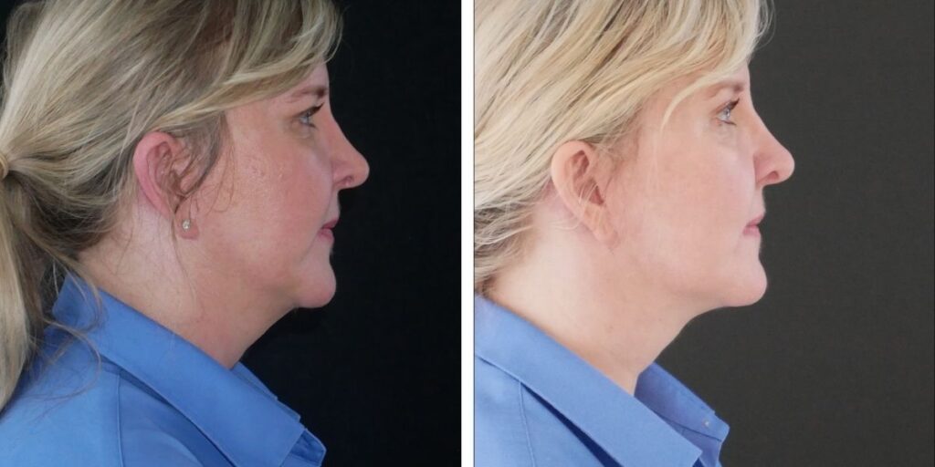 Side-by-side profile views of a woman with blonde hair in a blue shirt against a black background, showing before and after comparison. Saxon MD