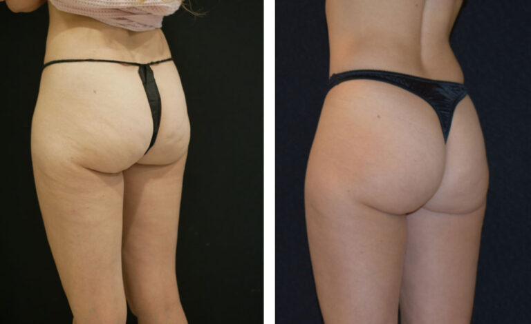 Before and after comparison of a woman's buttocks showing cellulite reduction treatment results. Saxon MD