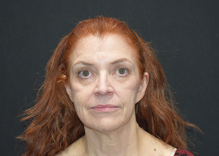 Middle-aged woman with red hair and fair skin looking directly at the camera against a black background. Saxon MD