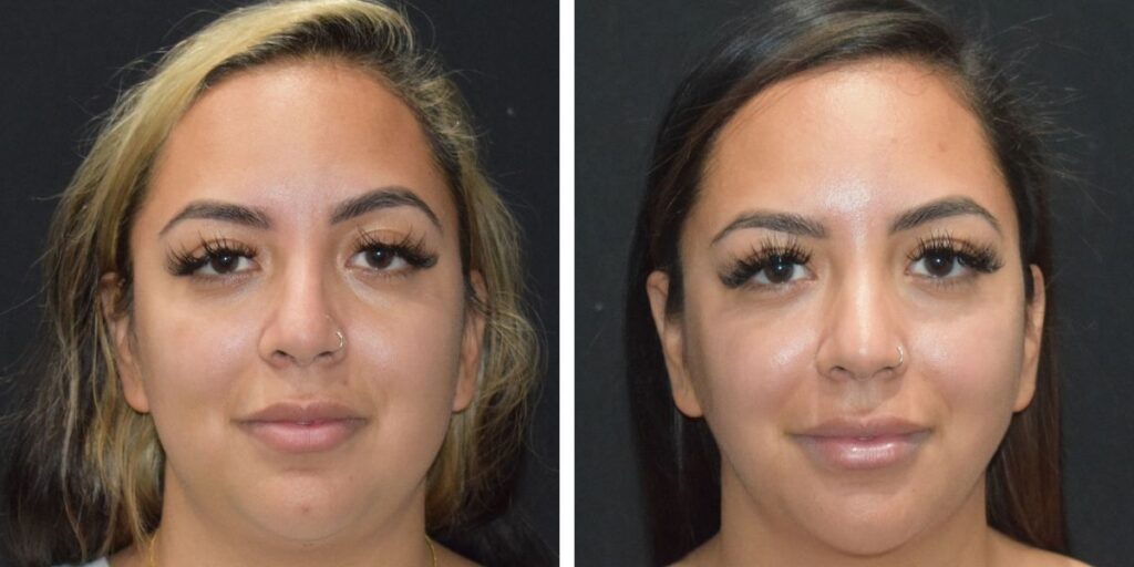 Before and after photos of a woman with and without facial acne. Saxon MD