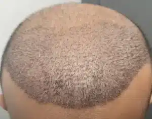 Hairline Lowering vs. Hair Grafts