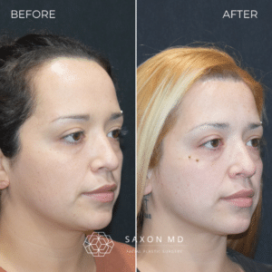 forehead reduction surgery before and after photo of a patient at Saxon MD in Austin, TX; hairline lowering before and after; receding hairline women