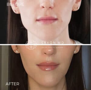 Lip Lift In Austin & Dallas, TX | Dr. Sarah Saxon