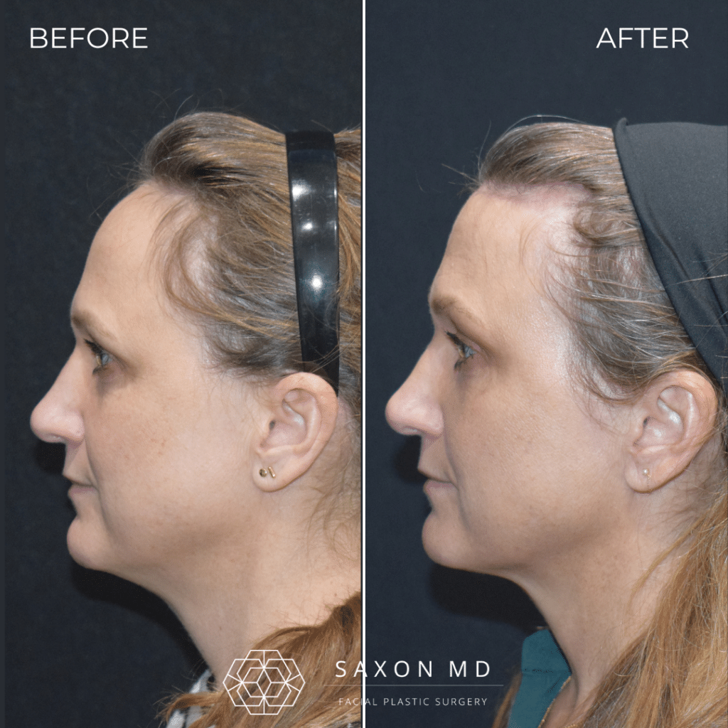 hairline lowering before and after photo of a patient at Saxon MD in Austin and Dallas, TX