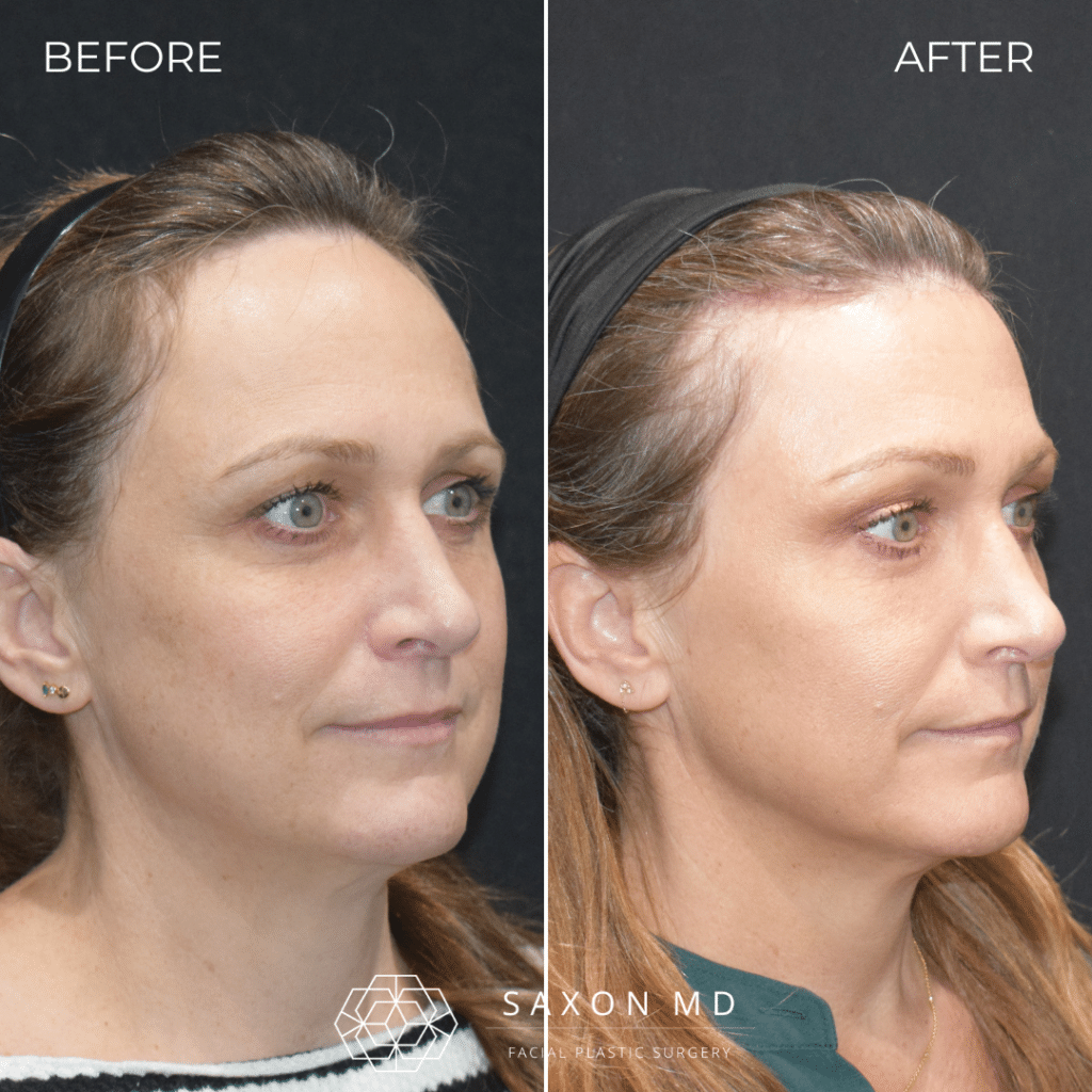 hairline lowering before and after photo of a patient at Saxon MD in Austin and Dallas, TX