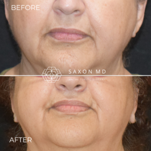 subnasal lip lift and corner lip lift before and after of a patient at Saxon MD in Austin, TX