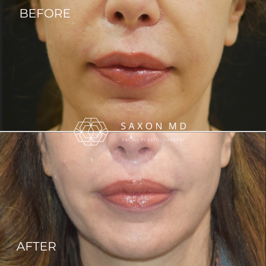 lip lift before and after photo of a patient at Saxon MD in Austin, TX