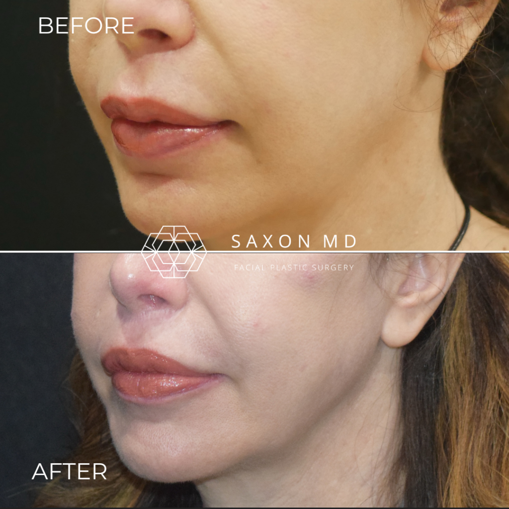 lip lift before and after photo of a patient at Saxon MD in Austin, TX