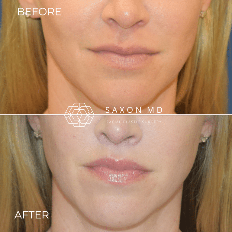 Before and after lip lift, front view, by Austin facial plastic surgeon Dr. Sarah Saxon