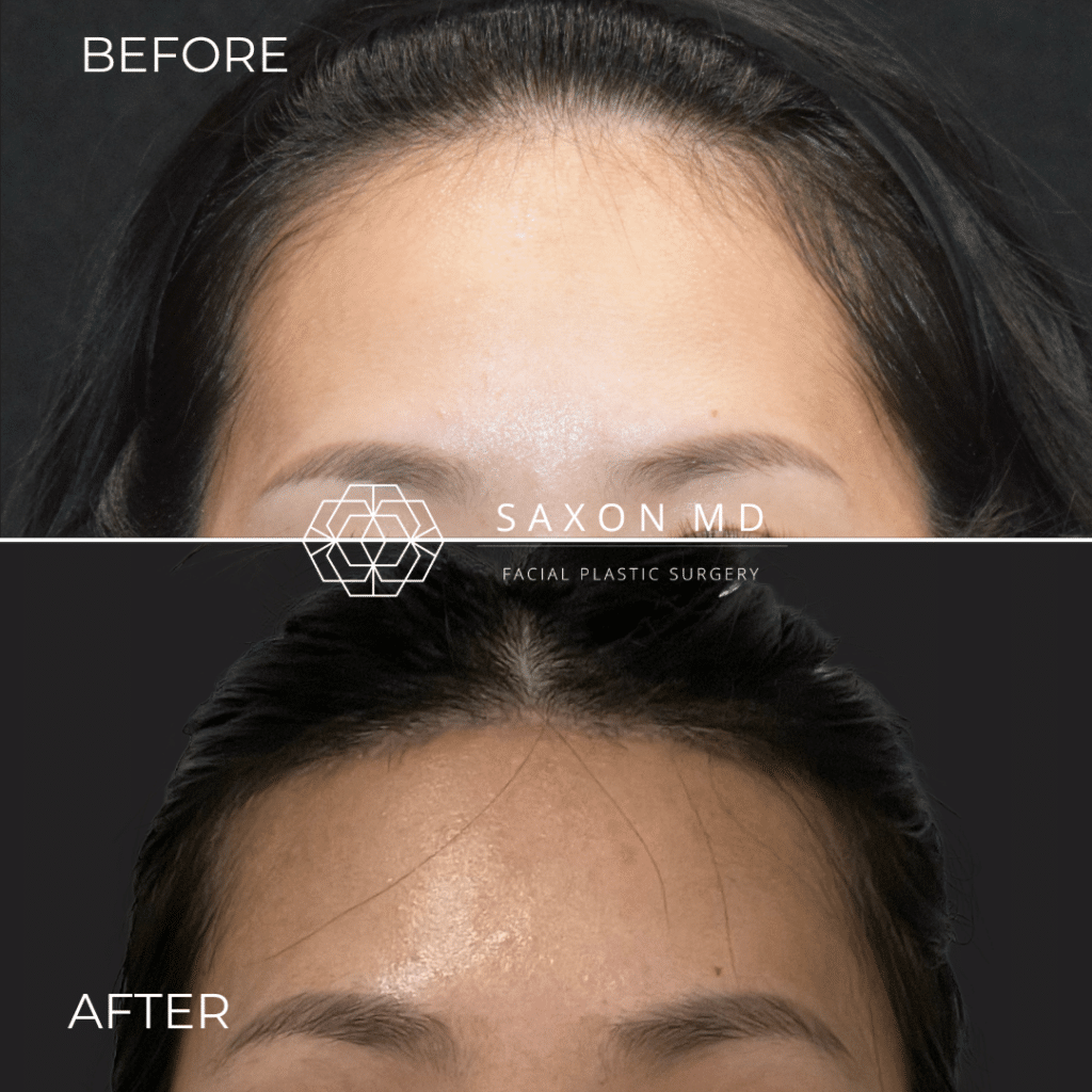 hairline lowering before and after photo of a patient at Saxon MD in Austin and Dallas, TX