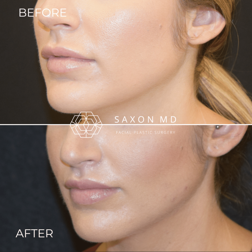 lip lift before and after photo with dermal augmentation at Saxon MD in Austin, TX