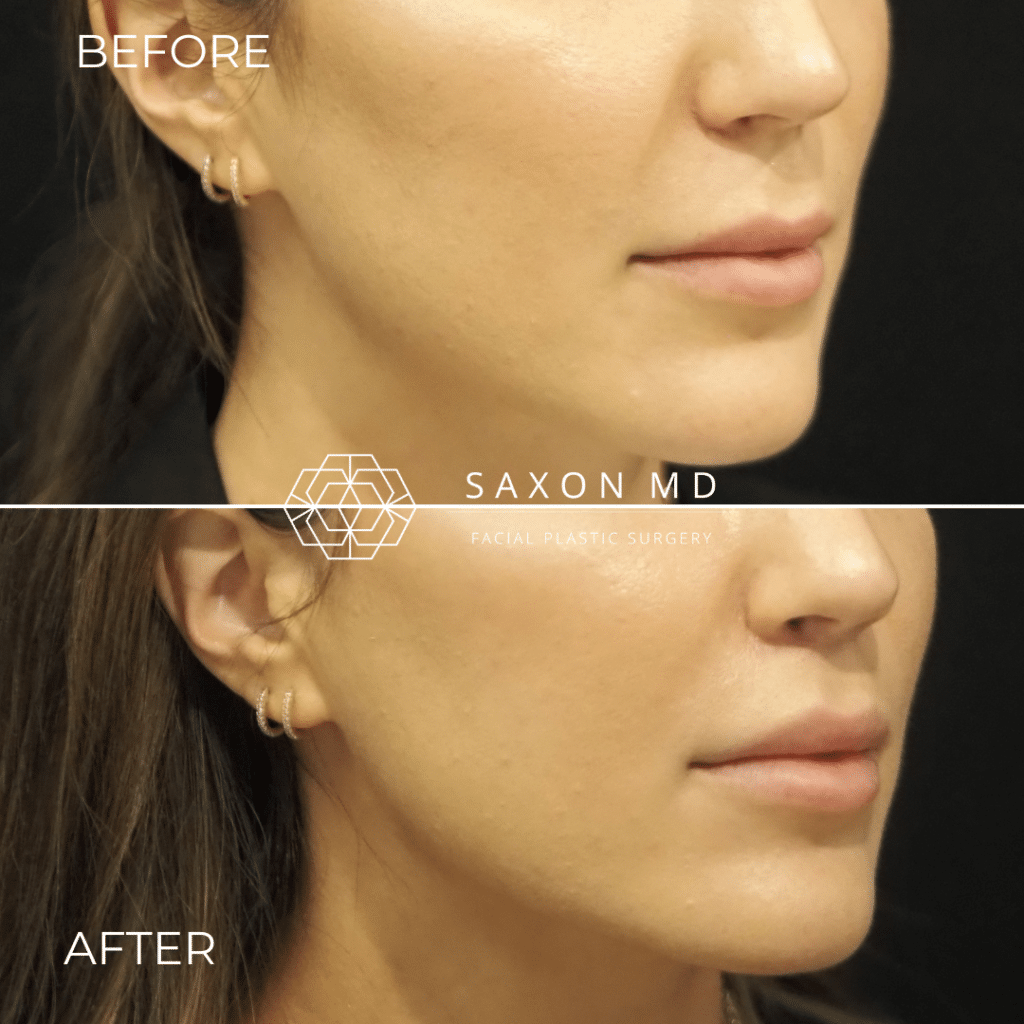 lip lift before and after photo at Saxon MD in Austin, TX