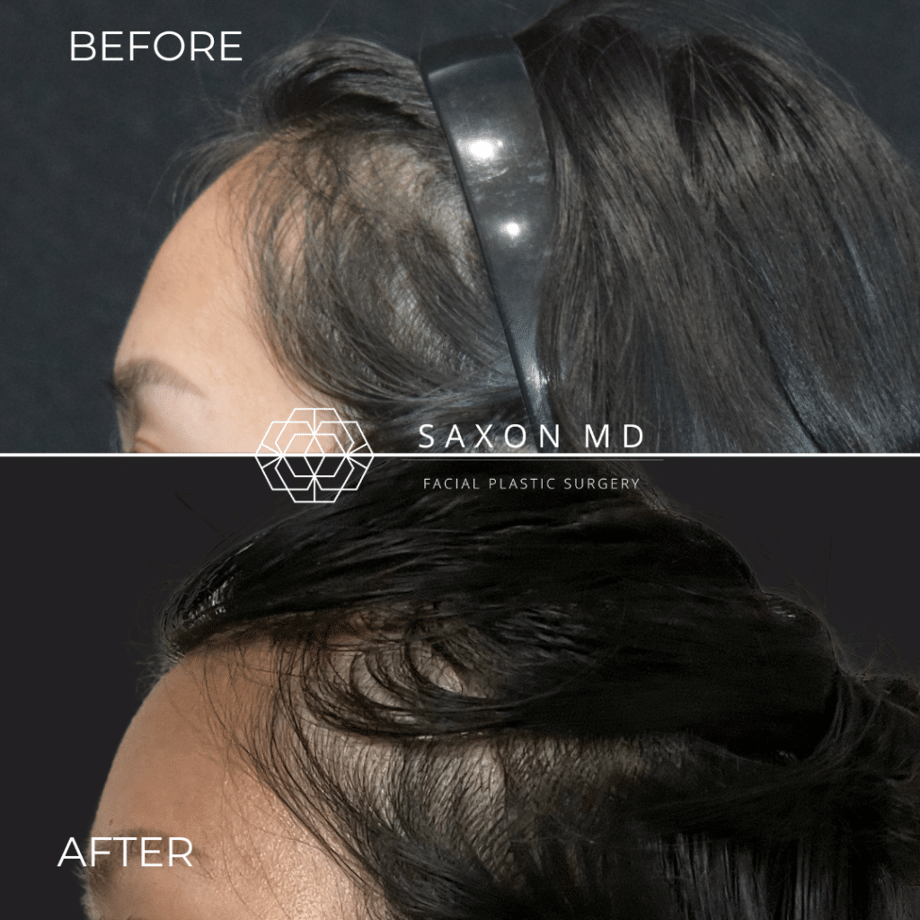 hairline lowering before and after photo of a patient at Saxon MD in Austin and Dallas, TX