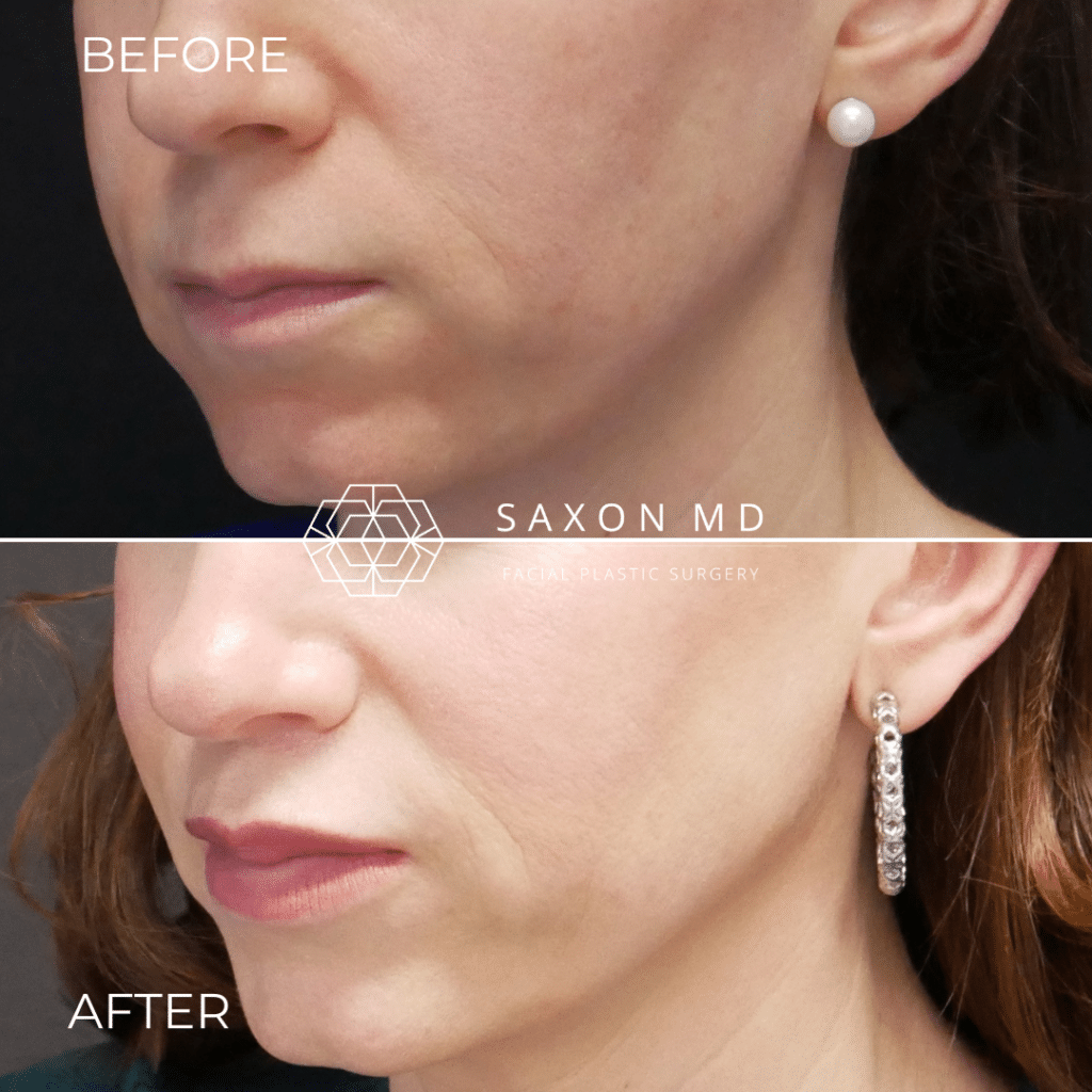 lip lift before and after photo of a patient at Saxon MD in Austin and Dallas, TX