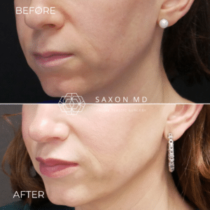 lip lift before and after photo of a patient at Saxon MD in Austin and Dallas, TX; how to avoid a botched lip lift