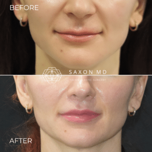 lip lift scar, lip lift austin, lip lift