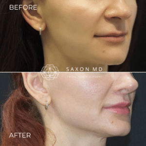 lip lift before and after photo of a patient at Saxon MD in Austin and Dallas, TX; how long does a lip lift last
