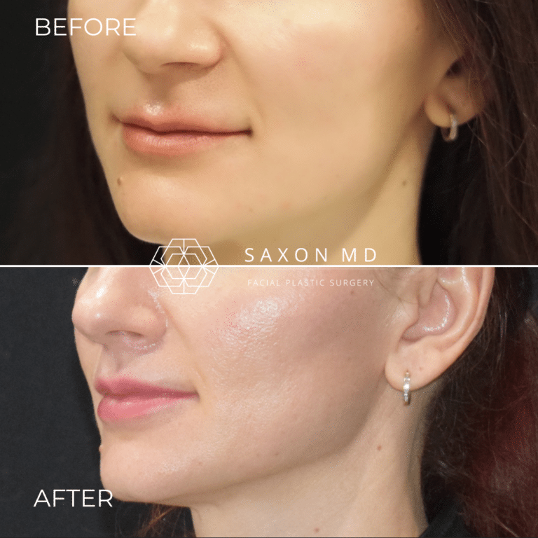 Before and after lip lift, three quarter view, by Austin facial plastic surgeon Dr. Sarah Saxon