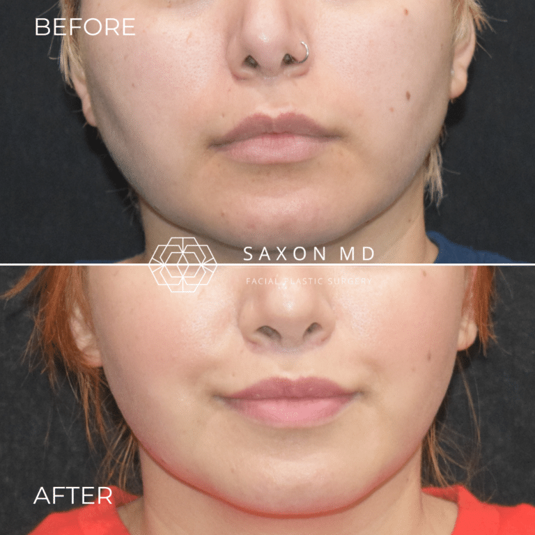 Before and after lip lift, front view, by Austin facial plastic surgeon Dr. Sarah Saxon