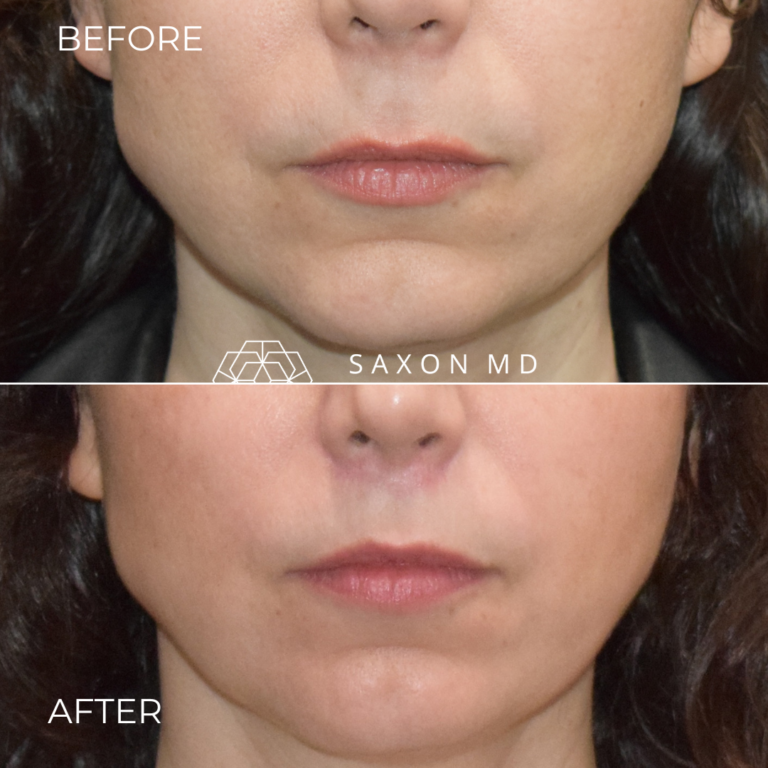 Before and after lip lift, front view of upper lip, by Austin facial plastic surgeon Dr. Sarah Saxon