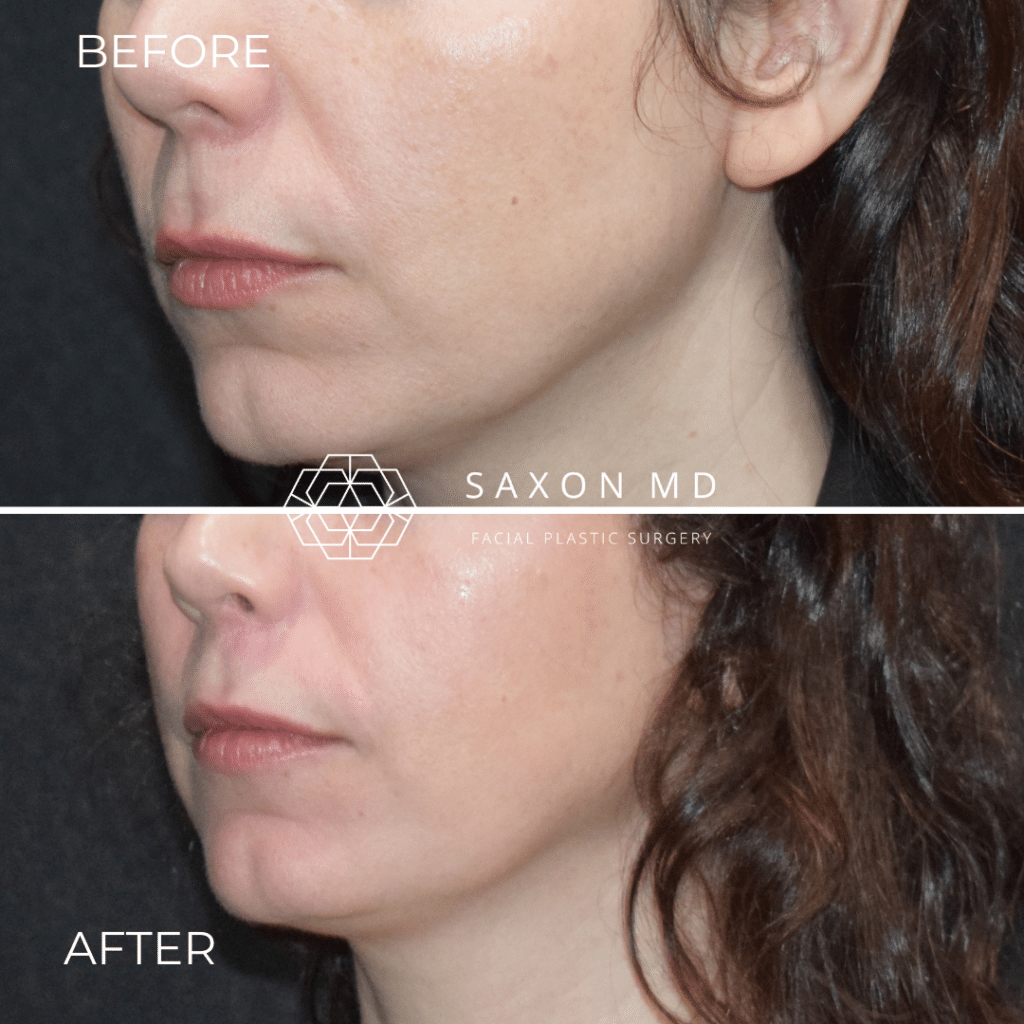 lip lift before and after photo of a patient at Saxon MD in Austin, TX