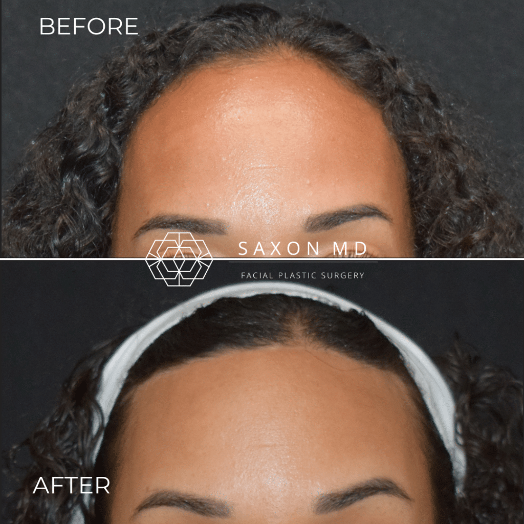 hairline lowering before and after photo of a patient at Saxon MD in Austin and Dallas, TX