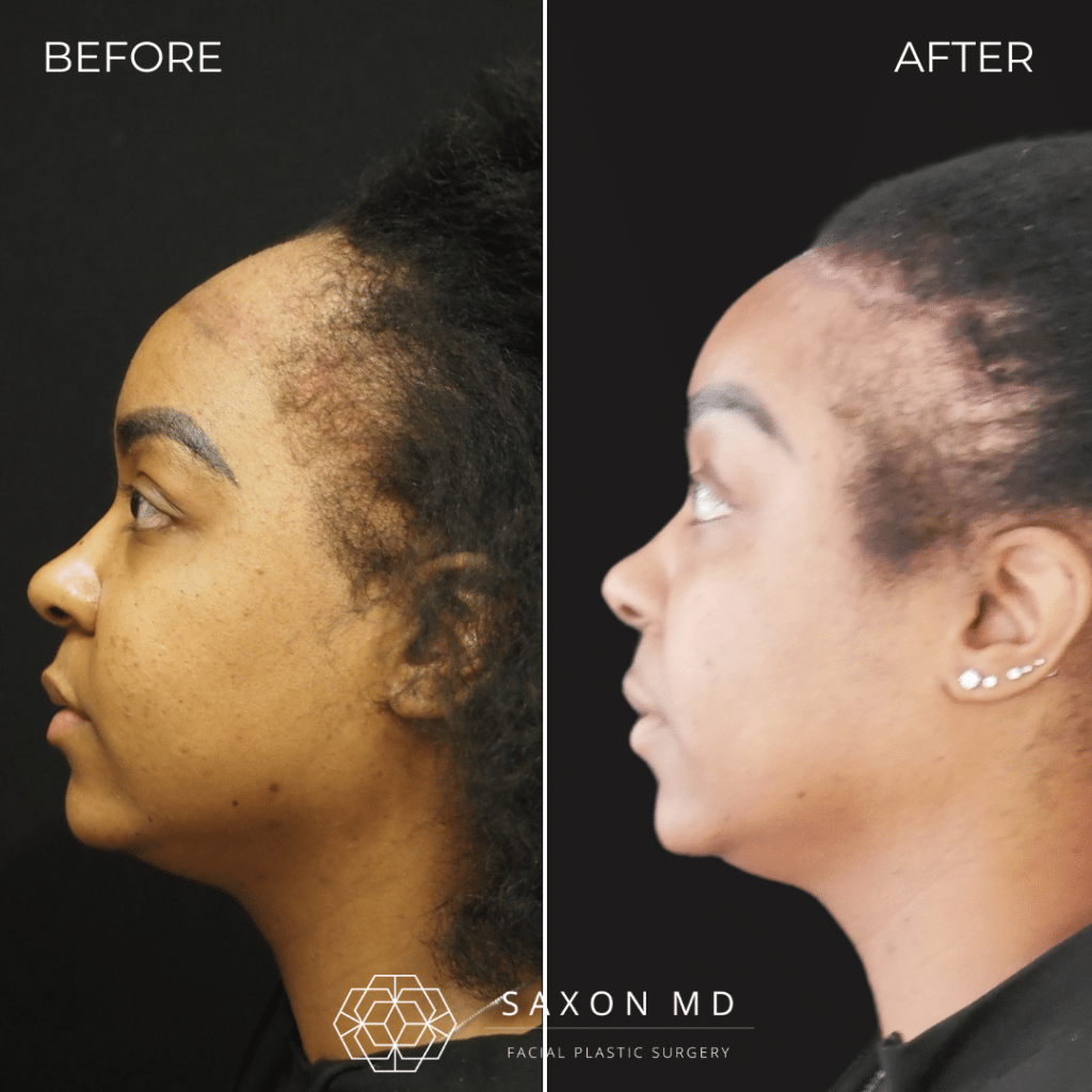 forehead reduction surgery before and after photo of a patient at Saxon MD in Austin, TX; hairline lowering before and after